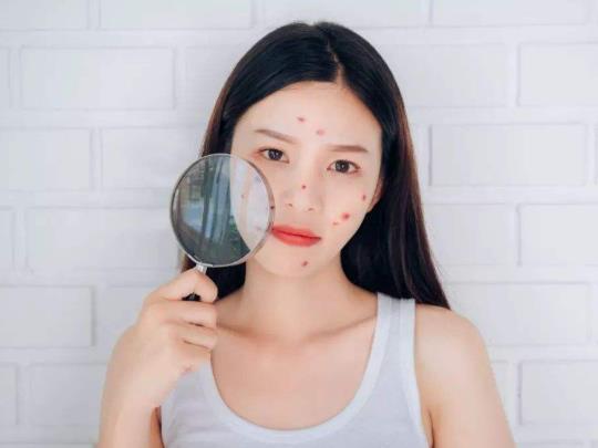 青春痘疫苗在哪里接種?青春痘疫苗2023年出來是真的嗎