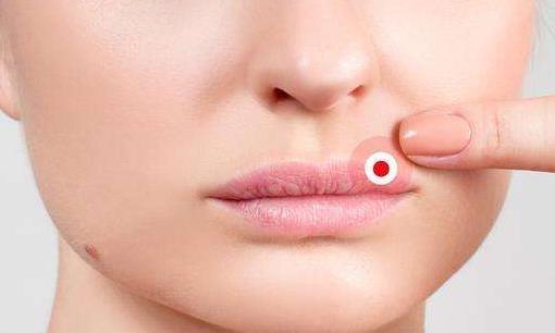 嘴唇起泡的原因有哪些?嘴唇起泡怎么辦?
