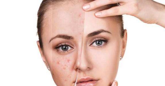 粉刺是生活中比較常見的一種皮膚病 三招教你對付粉刺