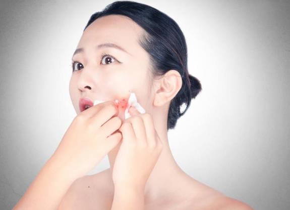 痘痘能不能擠?要不要擠?正確擠痘痘方法及擠痘痘的后續護理