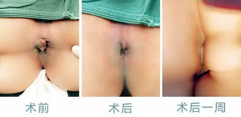 女性痔瘡真人實拍圖片 網上曝光的7個小偏方有效治痔瘡 女性痔瘡真人實拍圖片:網上曝光的7個小偏方有效治痔瘡