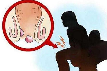 女性痔瘡真人實拍圖片 網上曝光的7個小偏方有效治痔瘡