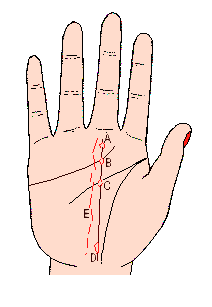 命運(yùn)線上的島形記號(hào)