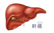  如何預防肝癌 ？