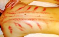 中醫刮痧要謹慎而行 哪些人不適合刮痧？