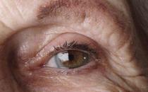 老人患上白內障的癥狀是什么