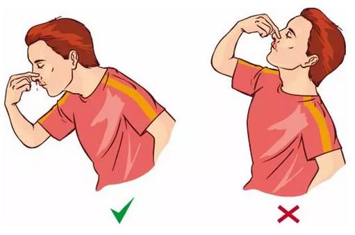 流鼻血怎么快速止血?