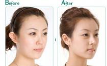 自體軟骨隆鼻尖整形手術效果怎樣？