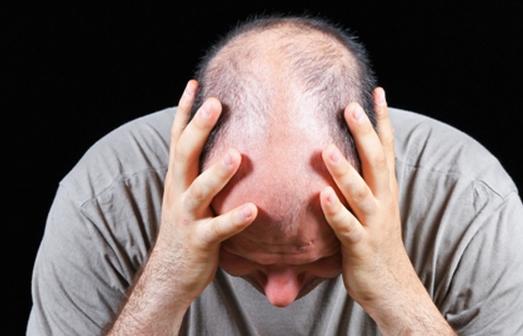 6招簡單防男性脫發(fā)