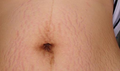 產后如何去除腹部妊娠紋