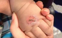 孩子常見的意外損傷類型有哪些？