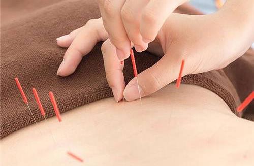針灸減肥別陷入這些誤區