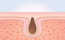 毛孔粗大吃什么好 收縮毛孔最佳飲食營養方案