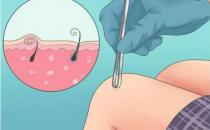 解決“毛發內生”的困擾 下面這些方法可幫你