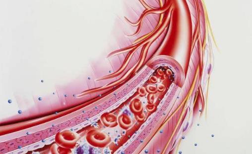 七類人重點防血栓 沖走血栓防住六成血管病