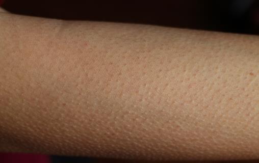 消除“雞皮疙瘩”，讓皮膚恢復光滑