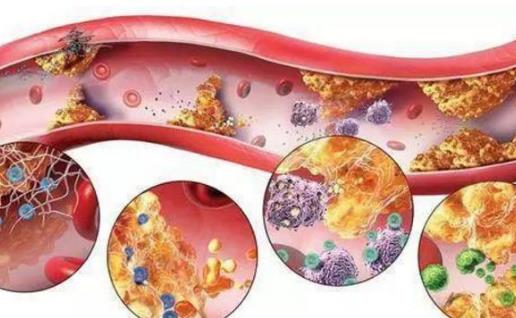 高血脂是現在高發的疾病之一,它本身屬于代謝類疾病,但