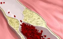 臉色發紅是血脂堵塞了血管 血脂過高的人常有的表現