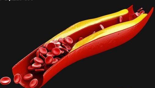 血脂總是上下波動？醫(yī)生：要注意這幾點，避免心腦血管出