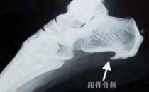 骨刺容易出現在這4個部位 骨刺患者不要隨便做按摩