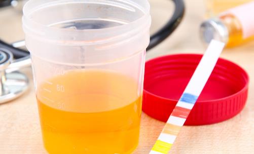 尿酸高需要吃藥的癥狀 尿酸高的日常控制法則