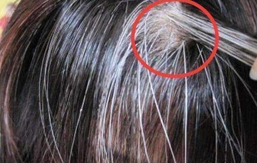 少年出現白頭發的主要原因 改善少年白的中醫技巧