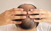 脫發厲害是身體出了問題 怎樣才能長出濃密秀發