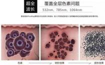 寧波薇琳整形醫院祛斑怎么樣？還您一張漂亮的容顏