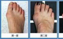 北京京醫中醫醫院治療拇外翻效果好嗎 治療安全有效有保障