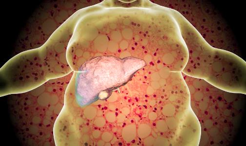 脂肪肝患者飲食禁忌有哪些 預防脂肪肝的食物要多吃