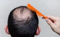 當代壓力大脫發的人越來越多 冬日防禿的日常妙招