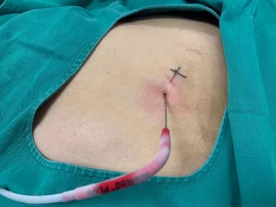 蘇州腫瘤醫院認準廣州復大醫院:有效治療雙腎腎癌