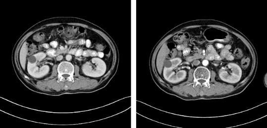 蘇州腫瘤醫院認準廣州復大醫院:有效治療雙腎腎癌