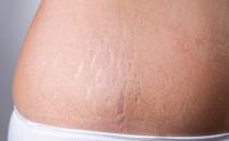 肥胖紋怎么消除 飲食合理規律作息肥胖紋也不再可怕