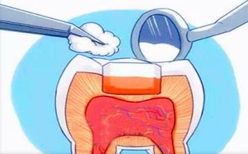 【補牙】補牙多少錢_補牙用什么材料最好_補牙掛哪個科_補牙后注意事項