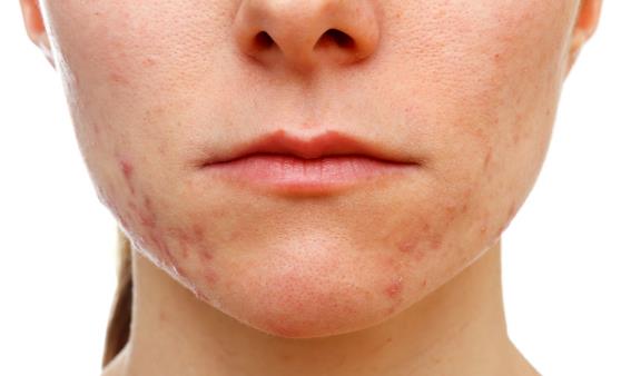 下巴長(zhǎng)痘痘怎么辦 祛痘小竅門(mén)