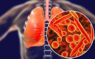 【新型冠狀病毒肺炎】新冠病毒感染肺炎早期癥狀、潛伏期、預防、治療 【新型冠狀病毒肺炎】新冠病毒感染肺炎早期癥狀、潛伏期、預防、治療