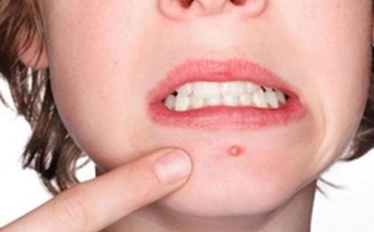 祛痘印小竅門(mén)學(xué)起來(lái) 讓女性顏值隨時(shí)在線(xiàn)