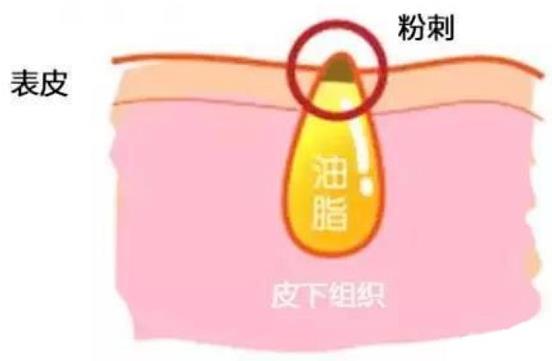 甲硝唑凝膠去黑頭要看主流，別拿個體差異混淆視聽