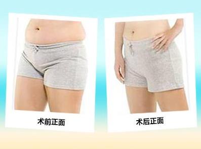 脂肪堆積怎么辦 昆明韓辰360幸福吸脂 無需住院 苗條立現