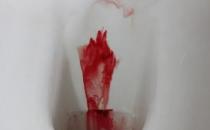 ?拉屎拉出血怎么回事 無疼痛鮮紅色吃什么藥